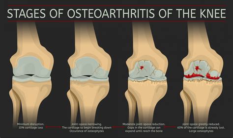 Knee Arthritis Treatment Osteoarthritis Symptoms Causes Advice | Hot ...