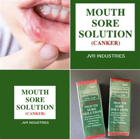 Effective mouth sore treatment tanggal singaw | Lazada PH