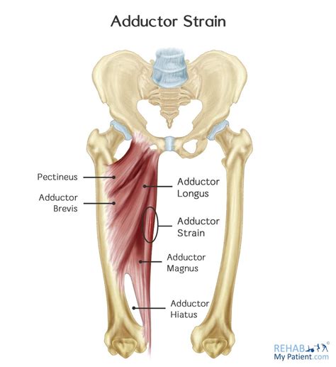 Adductor Strain | Rehab My Patient