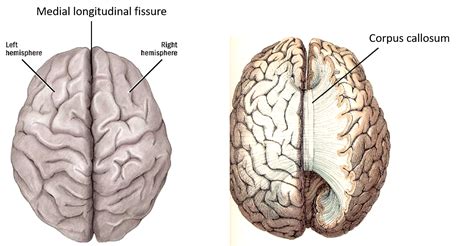 Corpus Callosum Diagram