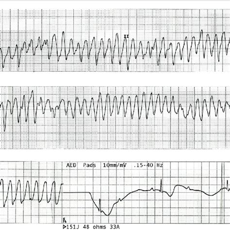 Ventricular Flutter Vs Torsades The Best Porn Website