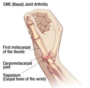 Thumb Arthritis: pain at the base of the thumb with increasing grip ...