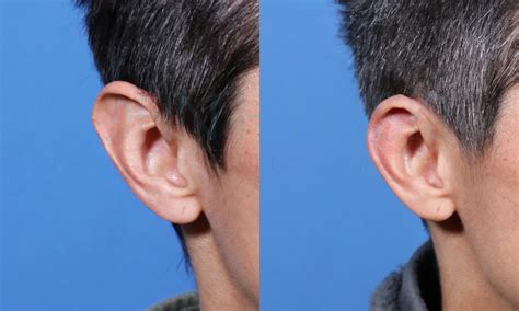 Smaller Ears with Macrotia Surgery Performed by Dr. John Hilinski ...