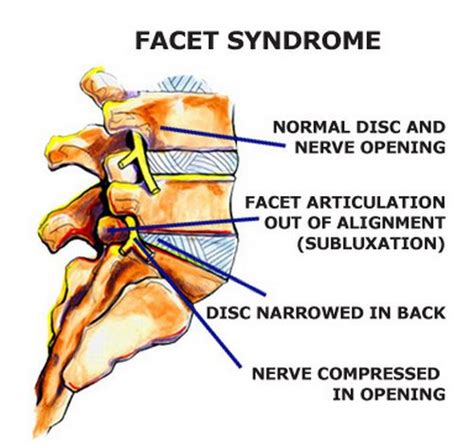 Facet Arthropathy - Definition, (lumbar, cervical, mild, moderate ...