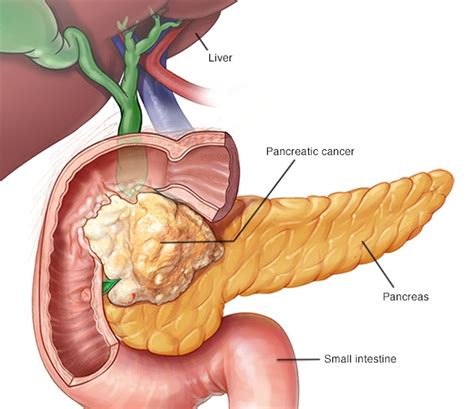 Gastroenterologists In Florida | Pancreatic Cancer (adenocarcinoma ...