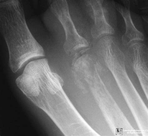 LearningRadiology | Radiographer, Arthritis, Radiology