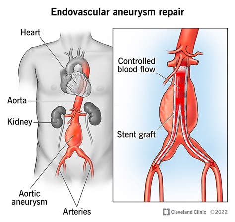 Treatment Options for Ascending Aortic Aneurysms: Surgical and Non ...