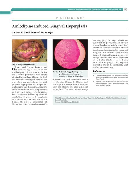 (PDF) Amlodipine Induced Gingival Hyperplasia