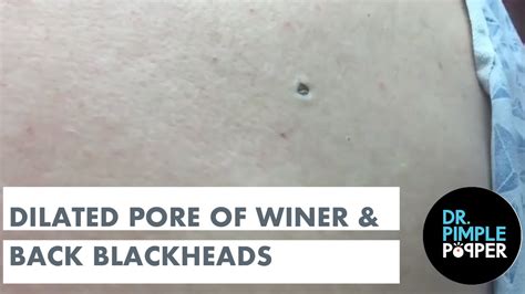 Dilated Pore of Winer and Blackheads on the Back - Dr. Pimple Popper