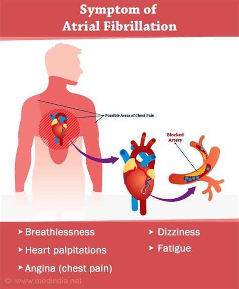 Atrial Fibrillation - Causes, Symptoms, Diagnosis, Treatment ...