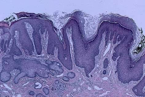 Congenital Nevus Histology