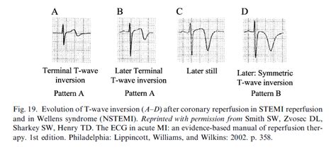 Wellens syndrome LITFL ECG Library