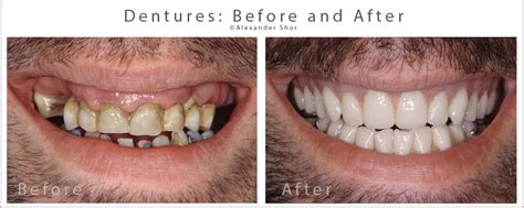 Dentures Before & After Seattle - Shor Dental