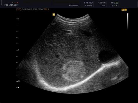 ULTRASOUND FINDINGS OF LIVER HEMANGIOMA - Wroc?awski Informator ...