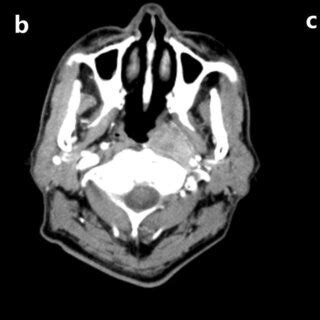 a CT image of parapharyngeal lymph node. b CT image of retropharyngeal ...