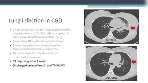 Lung Inflammation/Granuloma Problems with CGD - YouTube