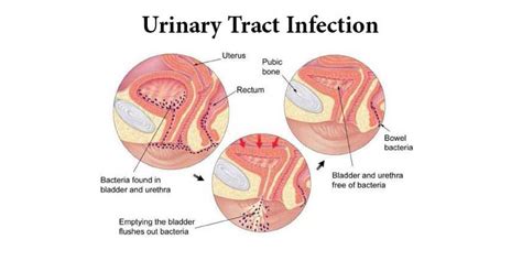 Uti Symptoms In Women