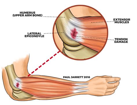 Lateral Epicondylitis - Camberwell Osteopathic Clinic