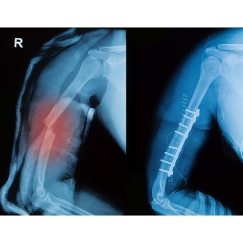 Humeral Shaft Fracture Fixation | Shoulder Surgeon | South Windsor ...