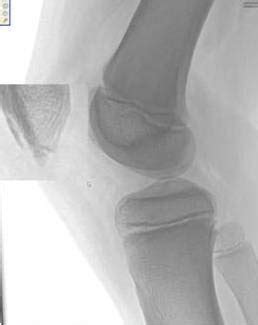 Patellar Sleeve Avulsion Fracture-Plain Film - Sumer's Radiology Blog