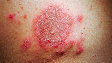 Eczema: Symptoms, Treatment, Causes, More