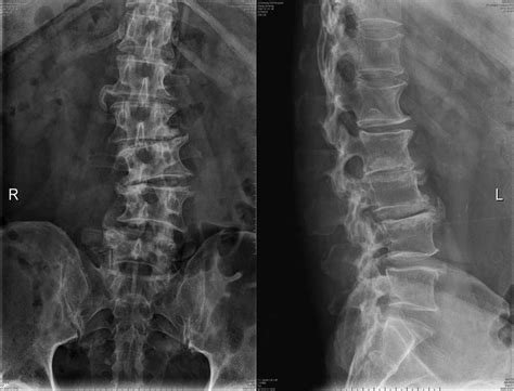 Plain radiographs of the lumbar spine shows degenerative lumbar ...