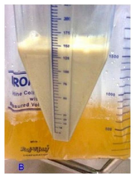 (a) Green urine—Pseudomonas-related urinary tract infection. (b) Milky ...