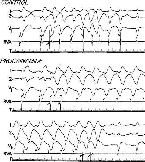 Ventricular Flutter Vs Torsades