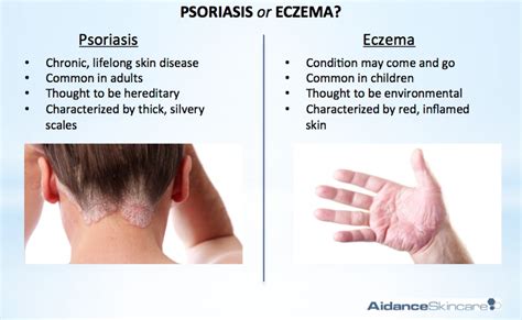 Difference Between Psoriasis And Dermatitis | Dorothee Padraig South ...