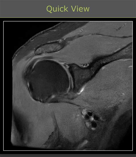 Slap tear. : r/Radiology