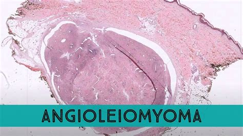 Angioleiomyoma (leiomyoma, vascular type) painful skin bump often on ...