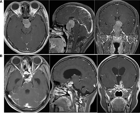 Pituitary Tumor Mri