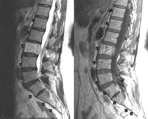 Introductory Spine Angiography | neuroangio.org