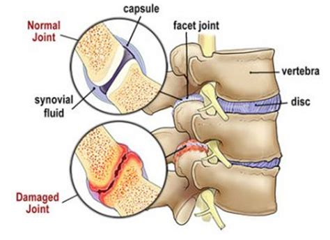 Facet syndrome - Chiropractor