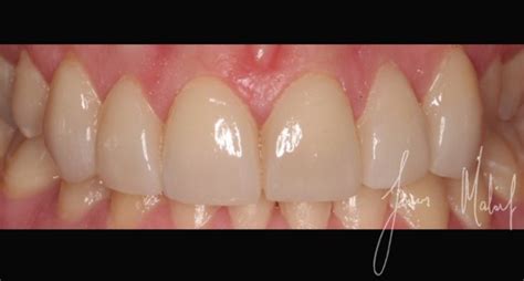 Porcelain Veneers are not just for Celebrities