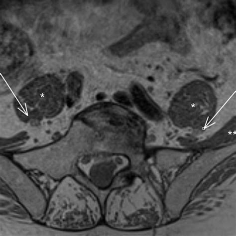 Normal anatomy of the femoral nerve (arrows). Psoas muscle (one ...