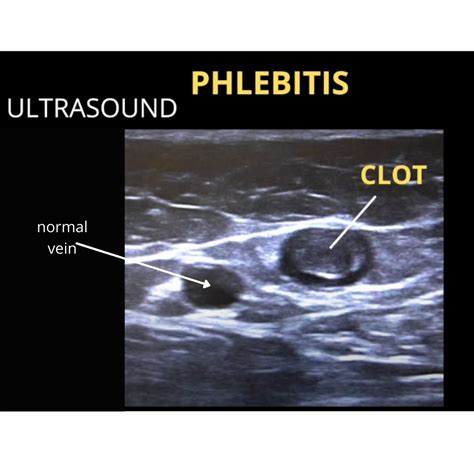 What Does Phlebitis of the Leg Look Like | with Pictures? | The ...