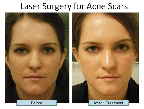 Laser Treatments For Acne Scars | Schweiger Dermatology Group