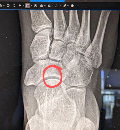 Navicular fracture? : r/Orthopedics