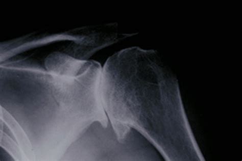 Shoulder Arthritis: An Overview