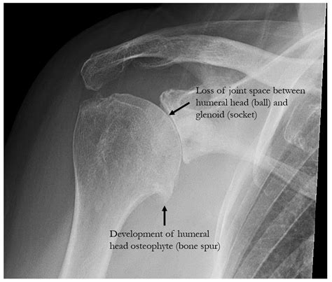 Shoulder Arthritis — Michael Fu, MD - HSS Shoulder Surgery