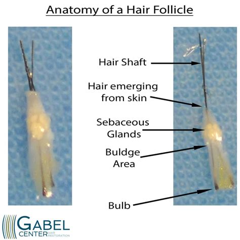 Hair Follicle Anatomy as it relates to hair transplant surgery