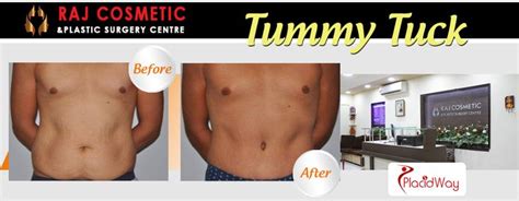 Before and After Tummy Tuck Surgery Chennai India | Tummy tuck surgery ...