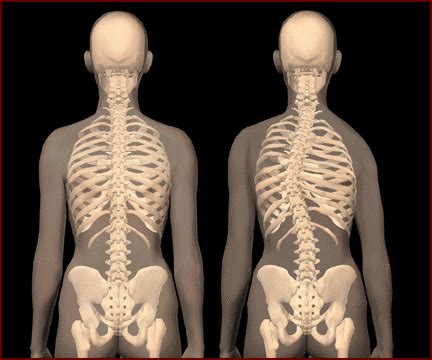 Scoliosis Treatment: What Is Scoliosis? What Causes Scoliosis?