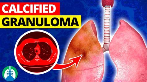 What is a Calcified Granuloma in the Lungs? - YouTube