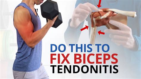 Exercises To Heal Distal Biceps Tendonitis Pain, 55% OFF