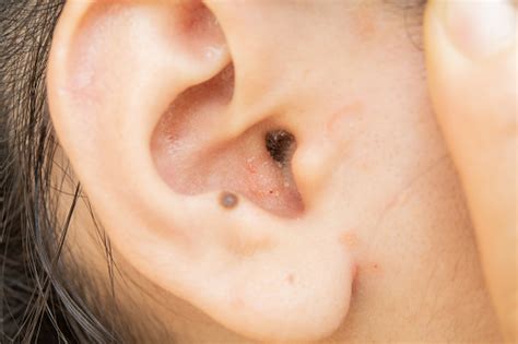 Dry Skin Disease In The Ear Stock Photo - Download Image Now - iStock