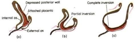 Inverted Uterus Diagram