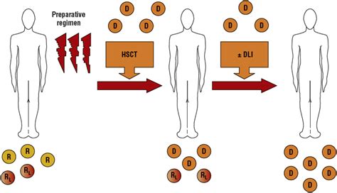 Hematopoietic Stem Cell Transplantation | Basicmedical Key