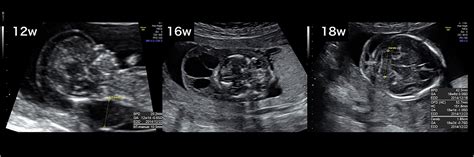 Increased Nuchal Translucency Ultrasound In